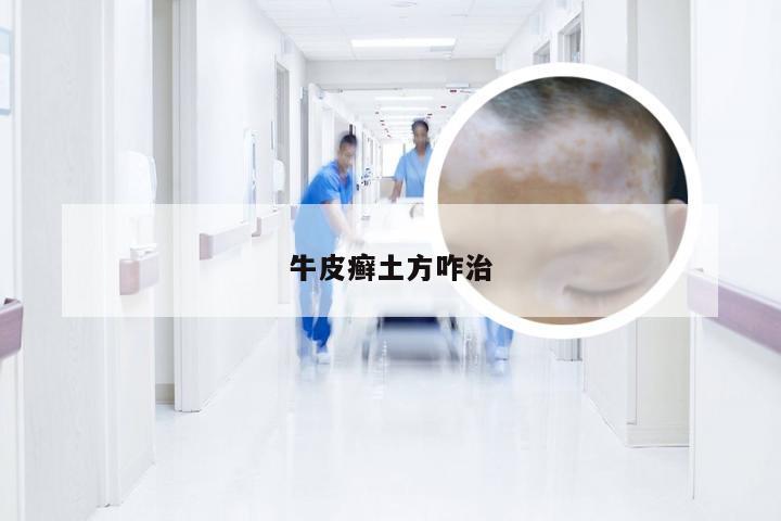牛皮癣土方咋治