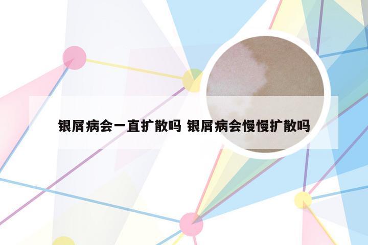 银屑病会一直扩散吗 银屑病会慢慢扩散吗