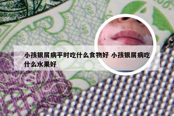 小孩银屑病平时吃什么食物好 小孩银屑病吃什么水果好