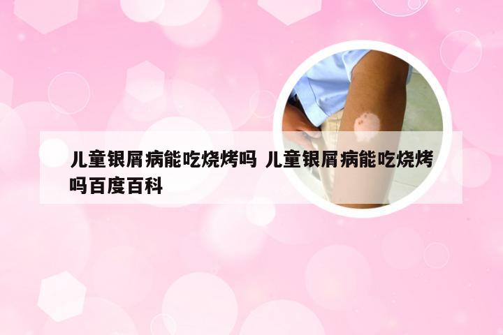 儿童银屑病能吃烧烤吗 儿童银屑病能吃烧烤吗百度百科