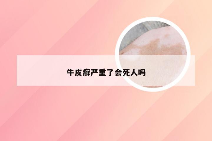 牛皮癣严重了会死人吗