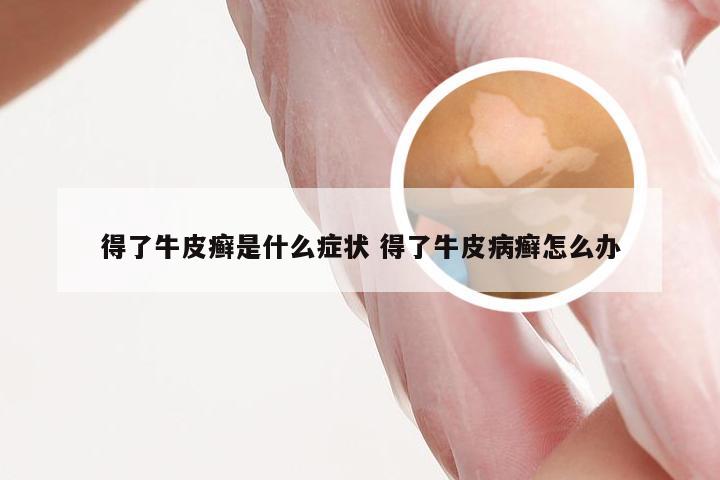 得了牛皮癣是什么症状 得了牛皮病癣怎么办