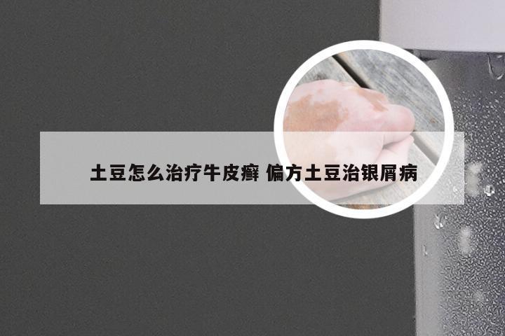 土豆怎么治疗牛皮癣 偏方土豆治银屑病