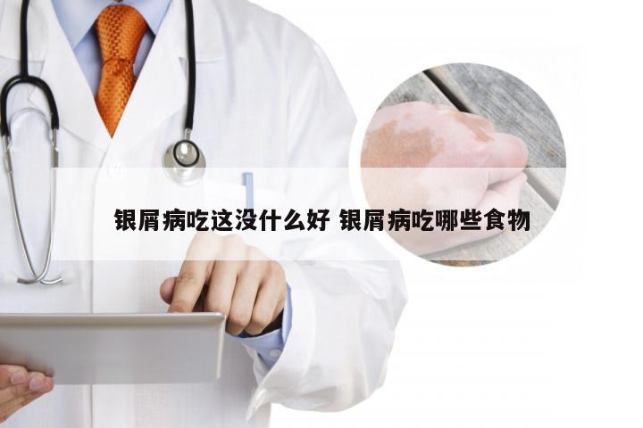 银屑病吃这没什么好 银屑病吃哪些食物