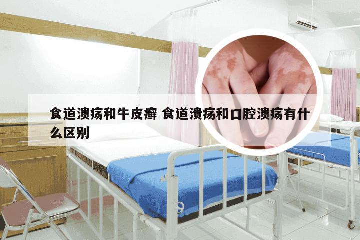 食道溃疡和牛皮癣 食道溃疡和口腔溃疡有什么区别