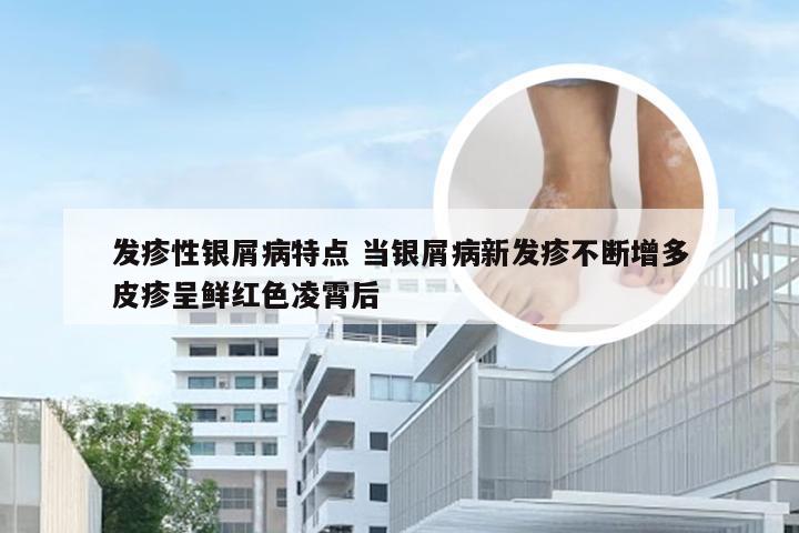 发疹性银屑病特点 当银屑病新发疹不断增多皮疹呈鲜红色凌霄后