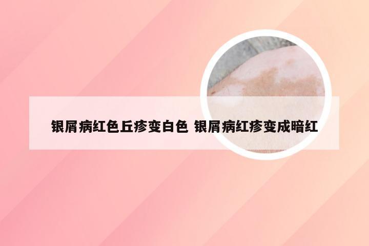 银屑病红色丘疹变白色 银屑病红疹变成暗红