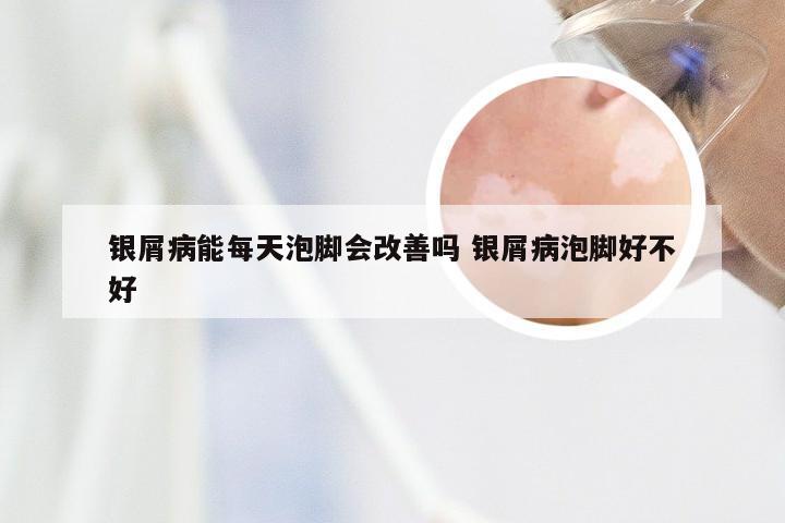 银屑病能每天泡脚会改善吗 银屑病泡脚好不好