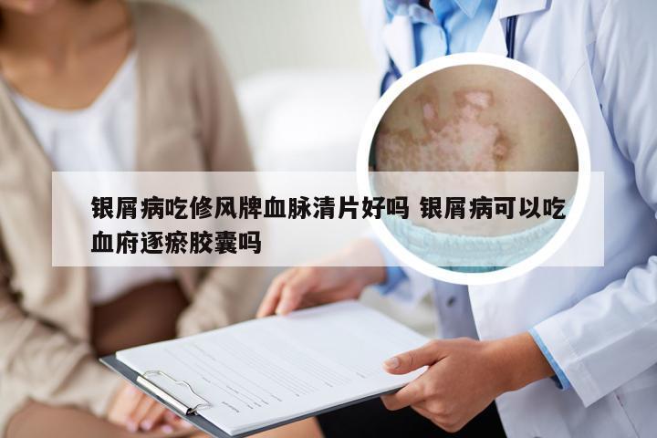 银屑病吃修风牌血脉清片好吗 银屑病可以吃血府逐瘀胶囊吗