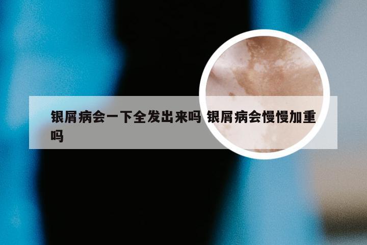 银屑病会一下全发出来吗 银屑病会慢慢加重吗