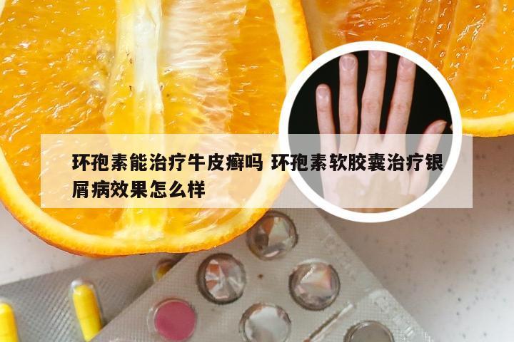 环孢素能治疗牛皮癣吗 环孢素软胶囊治疗银屑病效果怎么样