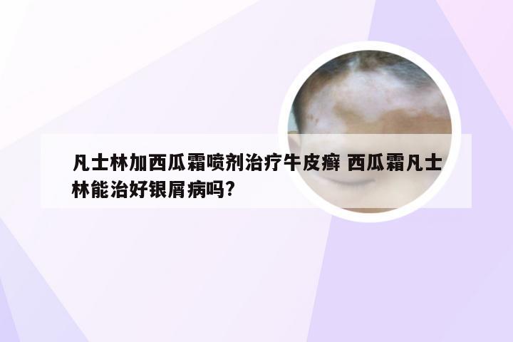 凡士林加西瓜霜喷剂治疗牛皮癣 西瓜霜凡士林能治好银屑病吗?