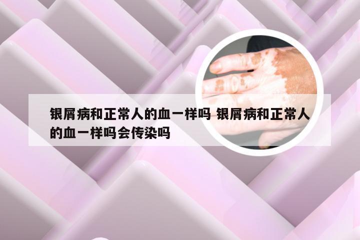 银屑病和正常人的血一样吗 银屑病和正常人的血一样吗会传染吗
