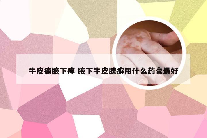 牛皮癣腋下痒 腋下牛皮肤癣用什么药膏最好