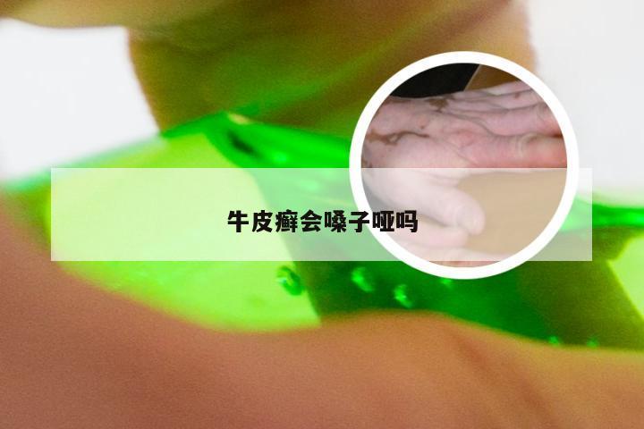 牛皮癣会嗓子哑吗