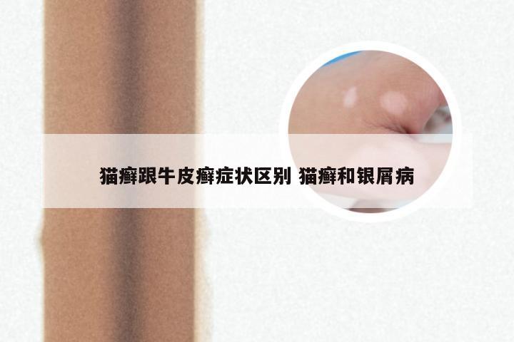 猫癣跟牛皮癣症状区别 猫癣和银屑病
