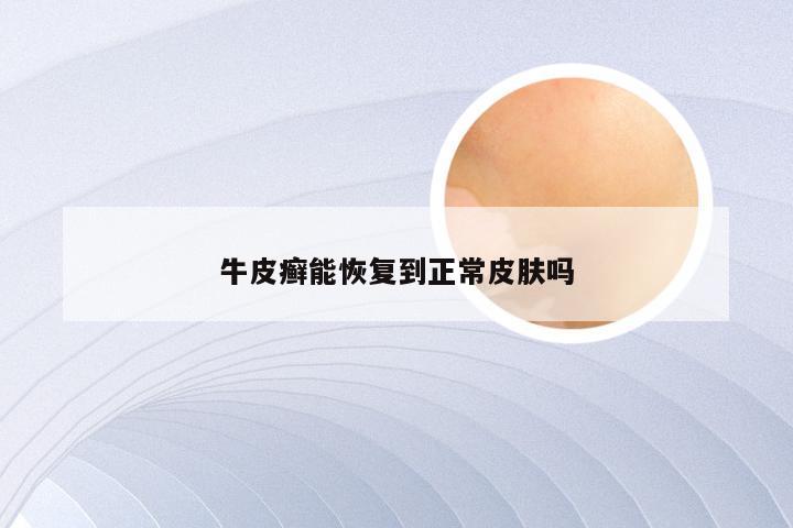 牛皮癣能恢复到正常皮肤吗