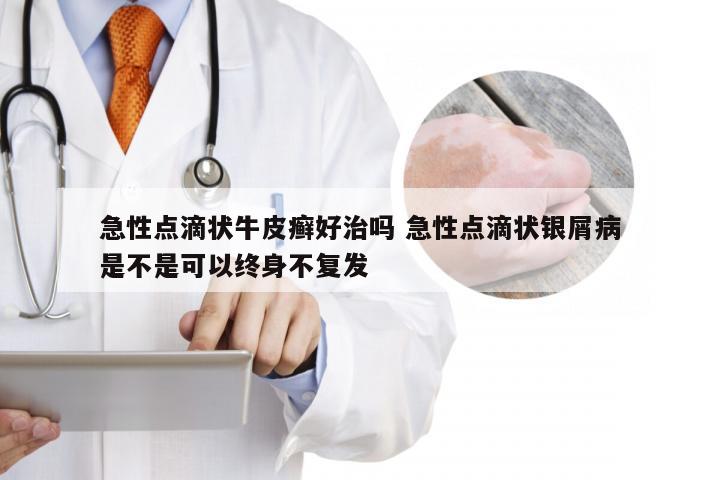 急性点滴状牛皮癣好治吗 急性点滴状银屑病是不是可以终身不复发