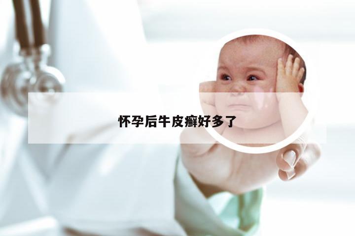 怀孕后牛皮癣好多了