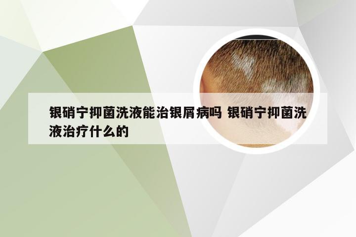 银硝宁抑菌洗液能治银屑病吗 银硝宁抑菌洗液治疗什么的