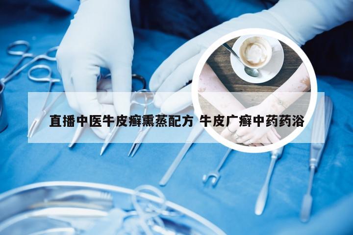 直播中医牛皮癣熏蒸配方 牛皮广癣中药药浴
