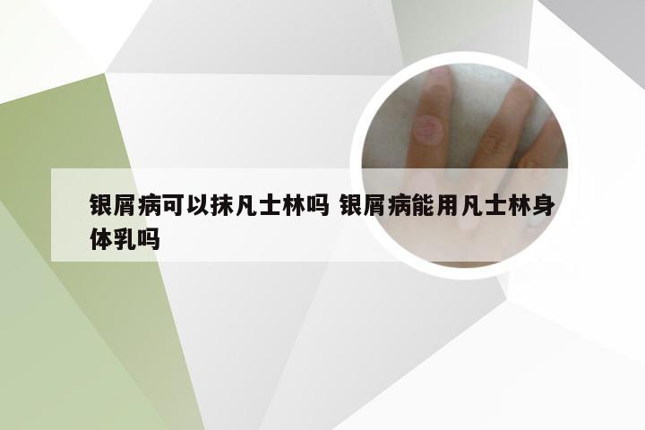 银屑病可以抹凡士林吗 银屑病能用凡士林身体乳吗