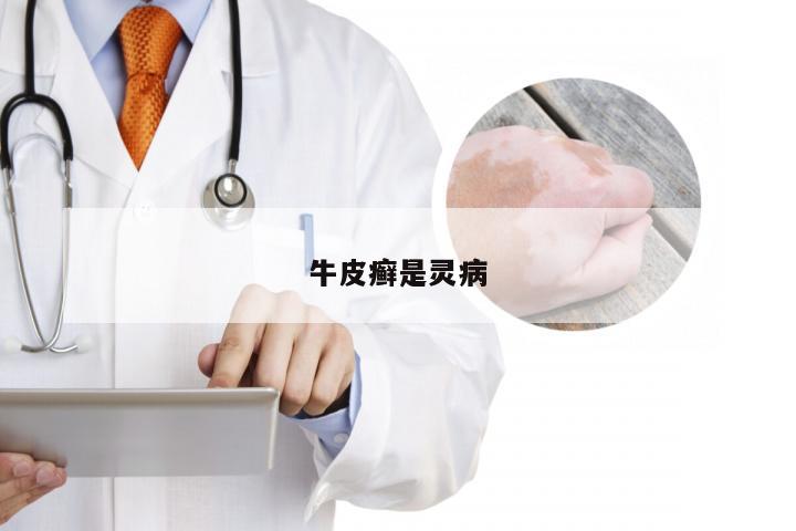 牛皮癣是灵病