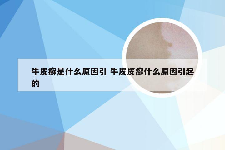 牛皮癣是什么原因引 牛皮皮癣什么原因引起的