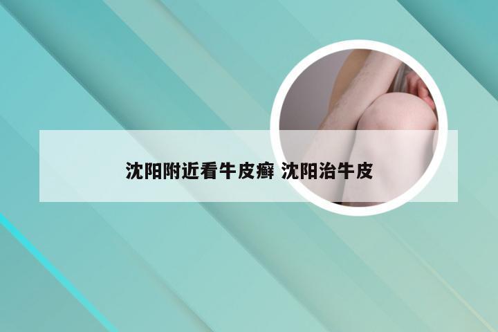 沈阳附近看牛皮癣 沈阳治牛皮