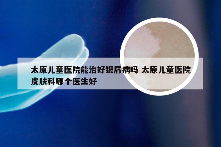 太原儿童医院能治好银屑病吗 太原儿童医院皮肤科哪个医生好