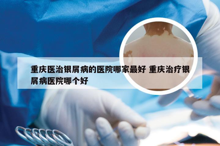 重庆医治银屑病的医院哪家最好 重庆治疗银屑病医院哪个好