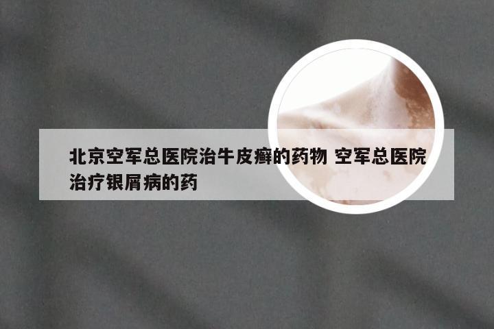 北京空军总医院治牛皮癣的药物 空军总医院治疗银屑病的药
