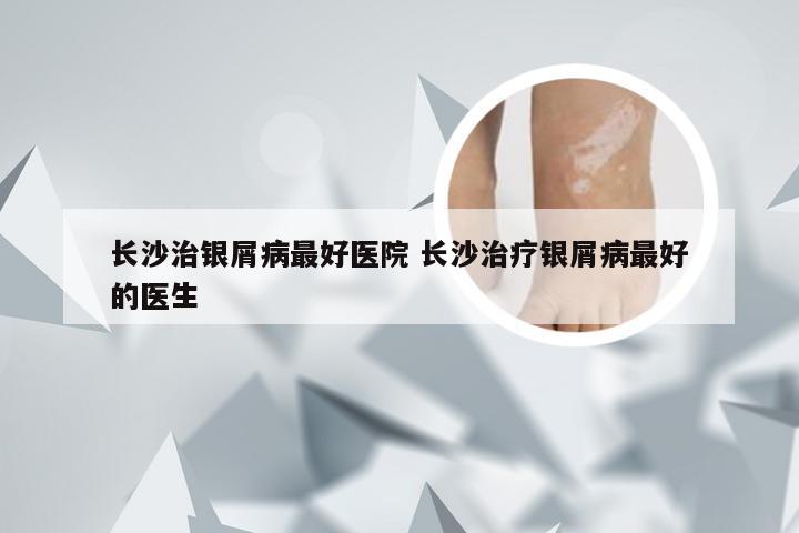 长沙治银屑病最好医院 长沙治疗银屑病最好的医生