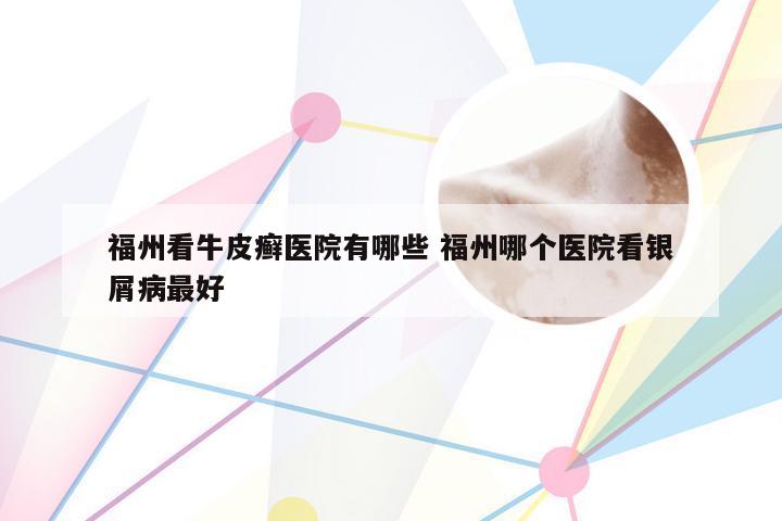 福州看牛皮癣医院有哪些 福州哪个医院看银屑病最好