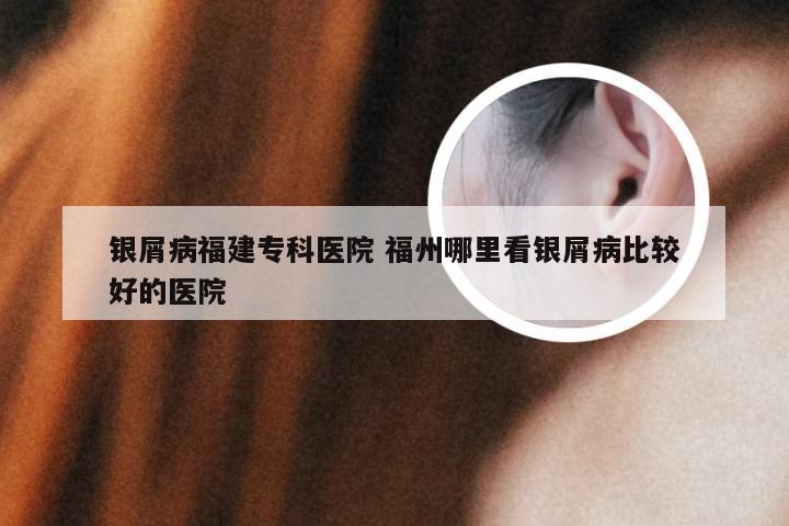 银屑病福建专科医院 福州哪里看银屑病比较好的医院