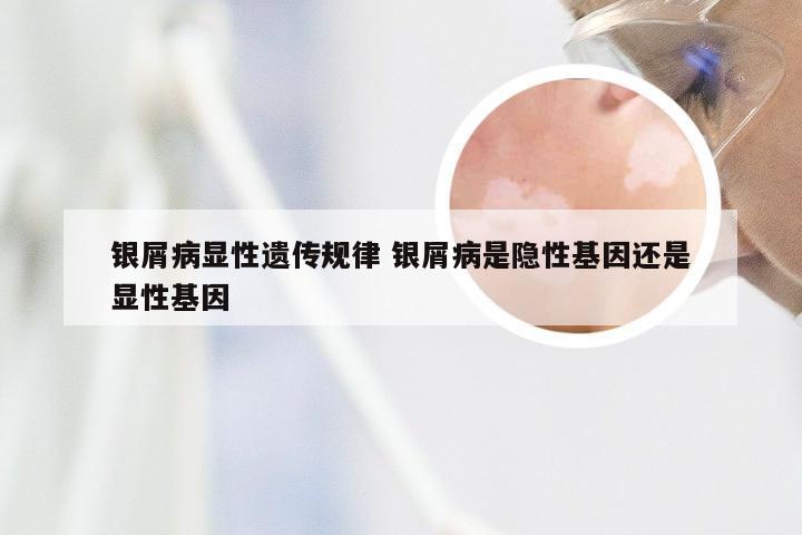 银屑病显性遗传规律 银屑病是隐性基因还是显性基因