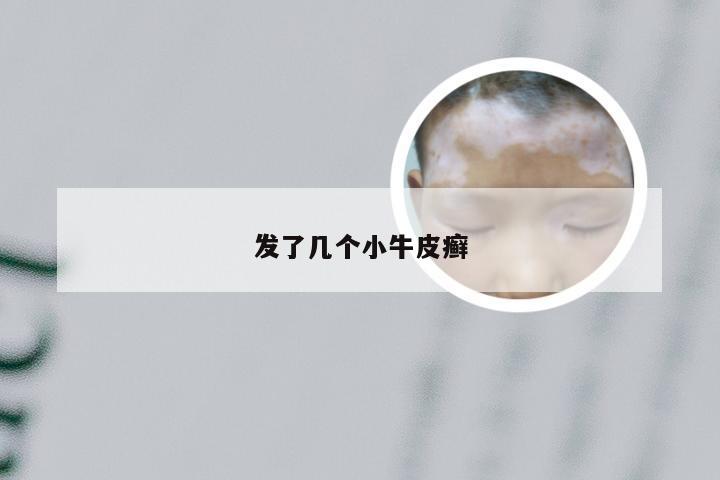 发了几个小牛皮癣
