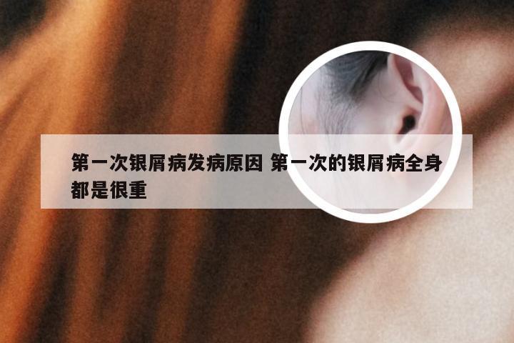 第一次银屑病发病原因 第一次的银屑病全身都是很重