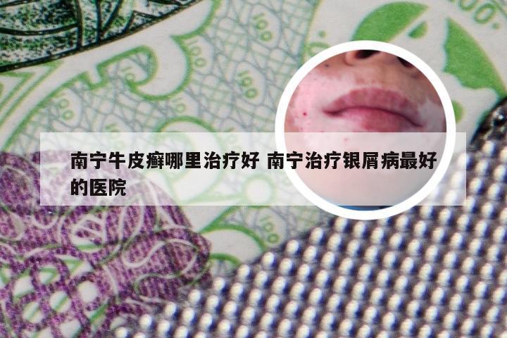 南宁牛皮癣哪里治疗好 南宁治疗银屑病最好的医院