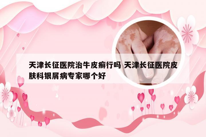 天津长征医院治牛皮癣行吗 天津长征医院皮肤科银屑病专家哪个好