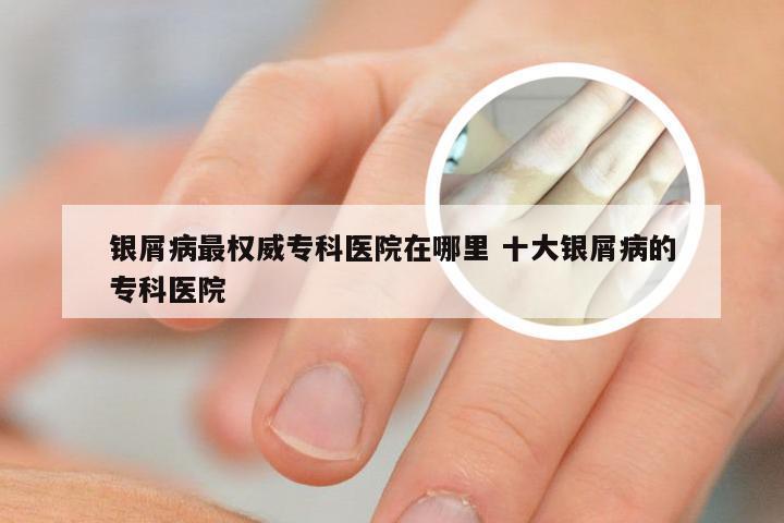 银屑病最权威专科医院在哪里 十大银屑病的专科医院