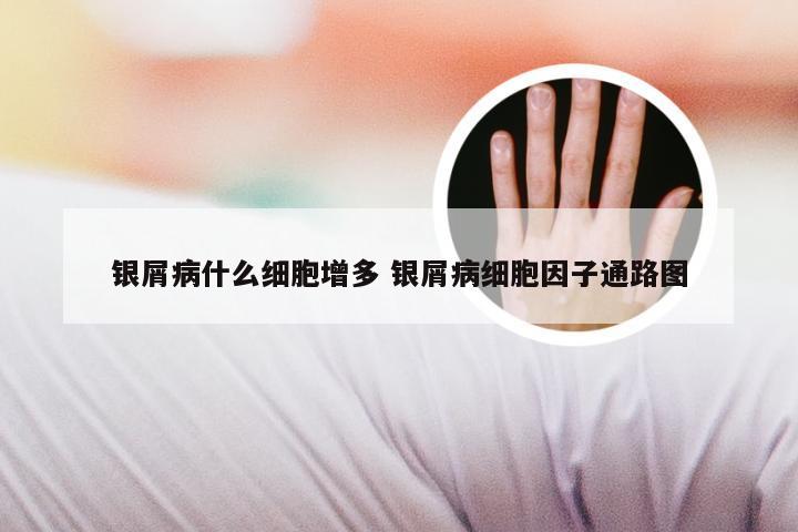 银屑病什么细胞增多 银屑病细胞因子通路图