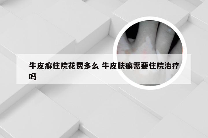 牛皮癣住院花费多么 牛皮肤癣需要住院治疗吗