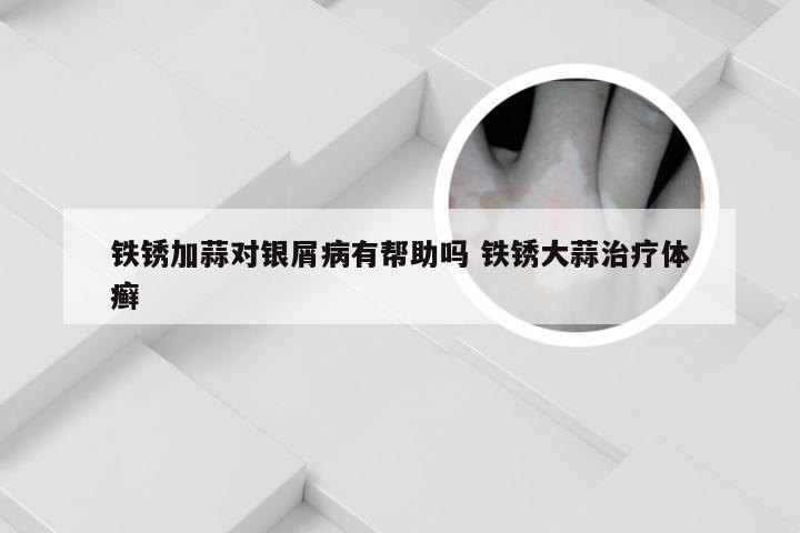 铁锈加蒜对银屑病有帮助吗 铁锈大蒜治疗体癣