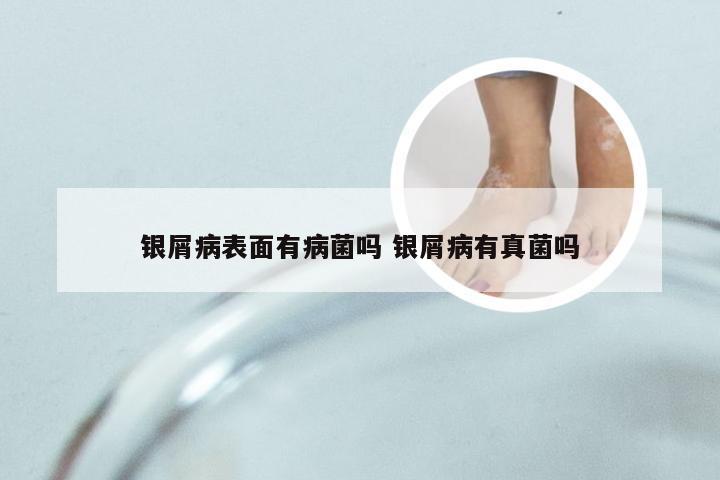 银屑病表面有病菌吗 银屑病有真菌吗