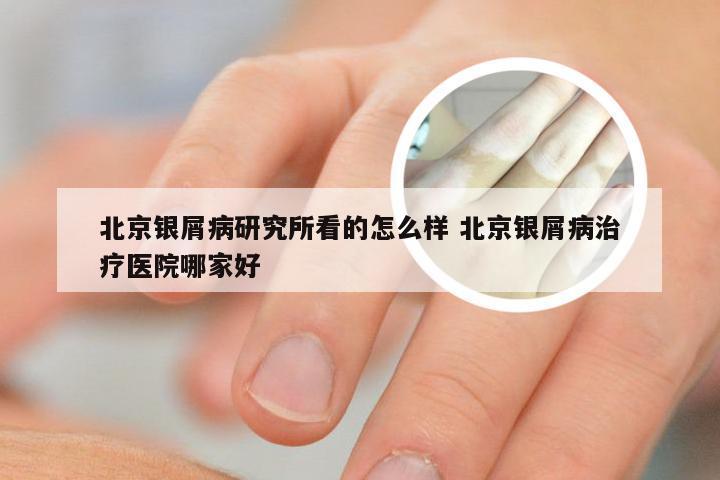 北京银屑病研究所看的怎么样 北京银屑病治疗医院哪家好