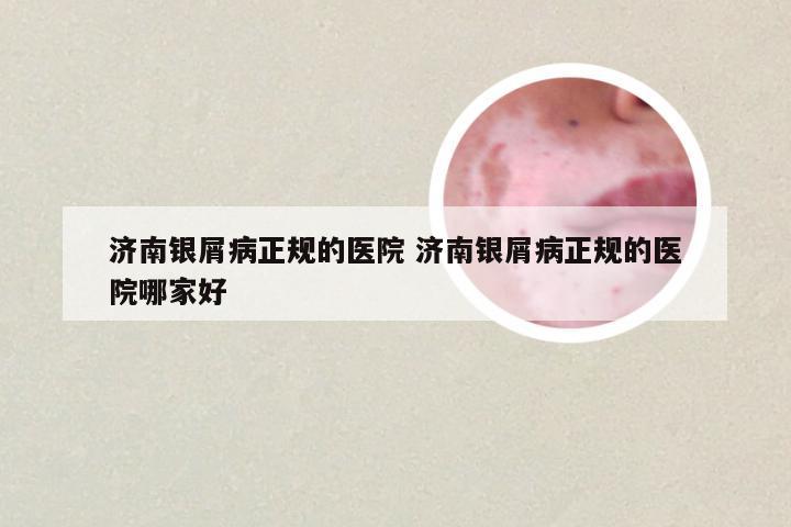 济南银屑病正规的医院 济南银屑病正规的医院哪家好