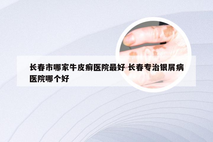 长春市哪家牛皮癣医院最好 长春专治银屑病医院哪个好