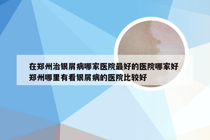 在郑州治银屑病哪家医院最好的医院哪家好 郑州哪里有看银屑病的医院比较好