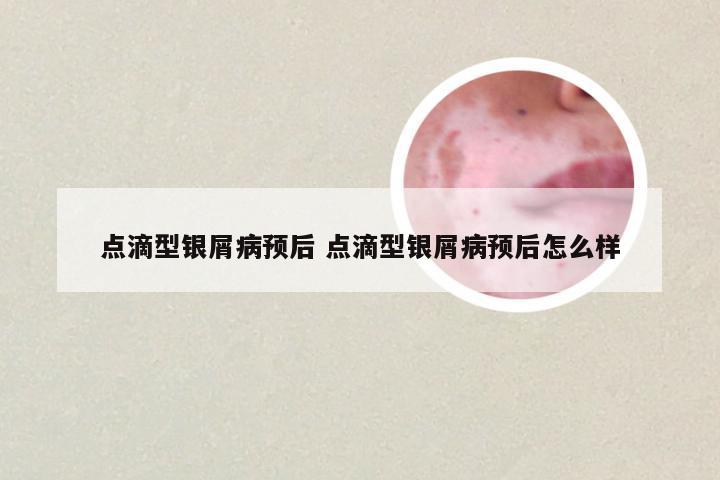 点滴型银屑病预后 点滴型银屑病预后怎么样
